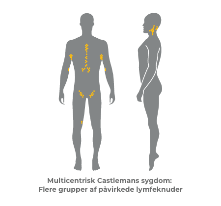 Multicentric Castleman disease